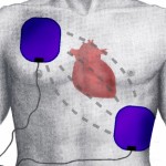 Defibrillation_Electrode_Position